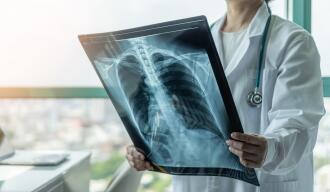 OG_DOCTOR_LOOKING_XRAY_LUNG_CANCER_ISTOCK_2021