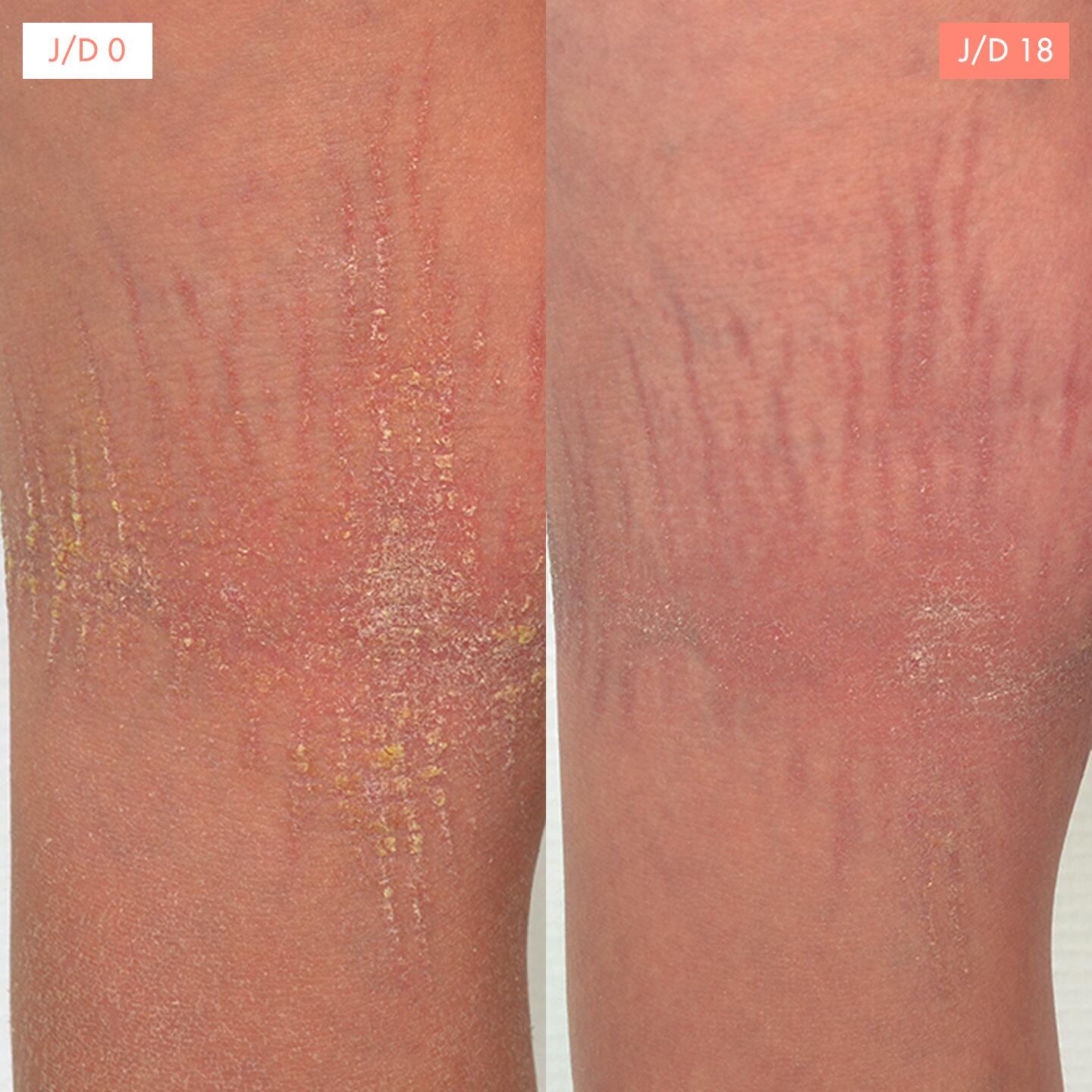 av_treatment-result-ictyosis-d0d18