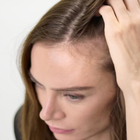 Chute de cheveux… La femme également touchée par l’alopécie et la calvitie
