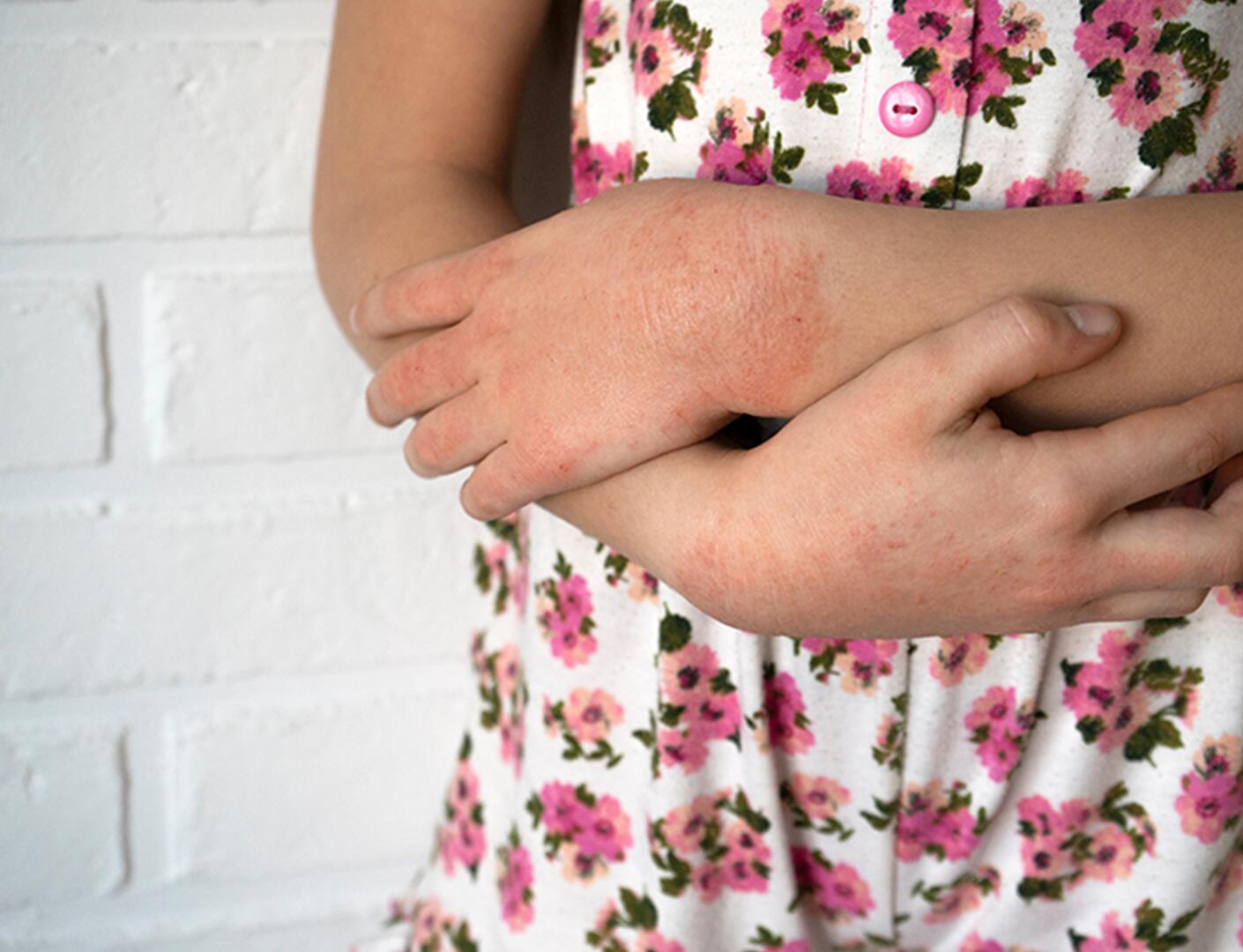 du_neurodermitis_silo_psoriasis_kinder_textmodul1_desktop_705x540