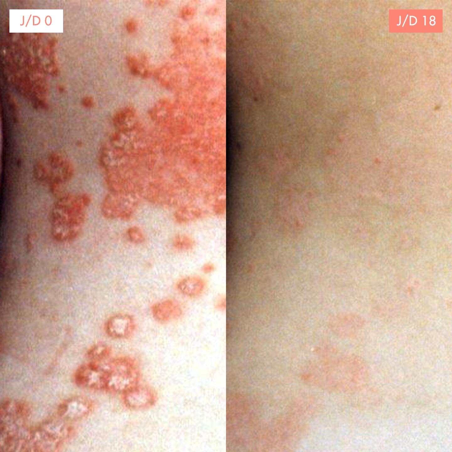 AV_treatment-result-psoriasis-d0d18