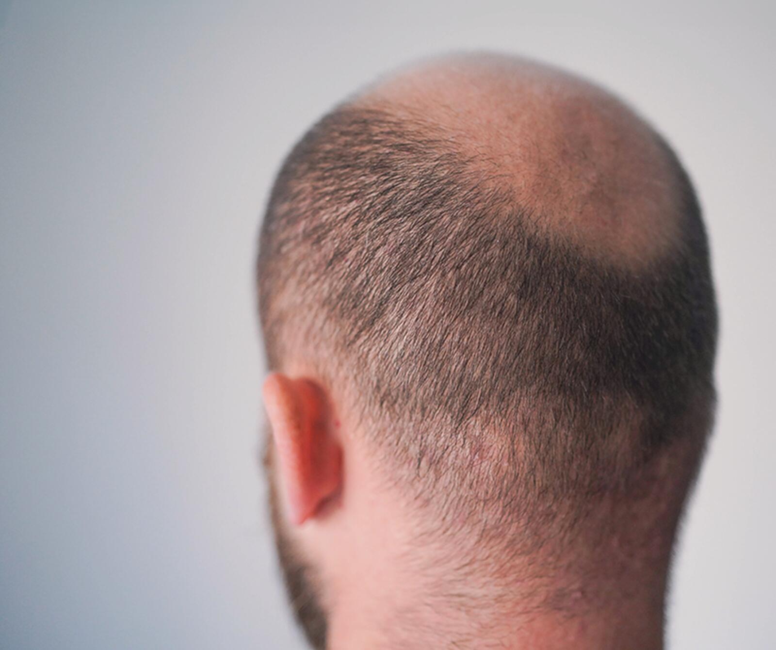Ursachen, Verlauf und Behandlung von genetisch bedingtem Haarausfall
