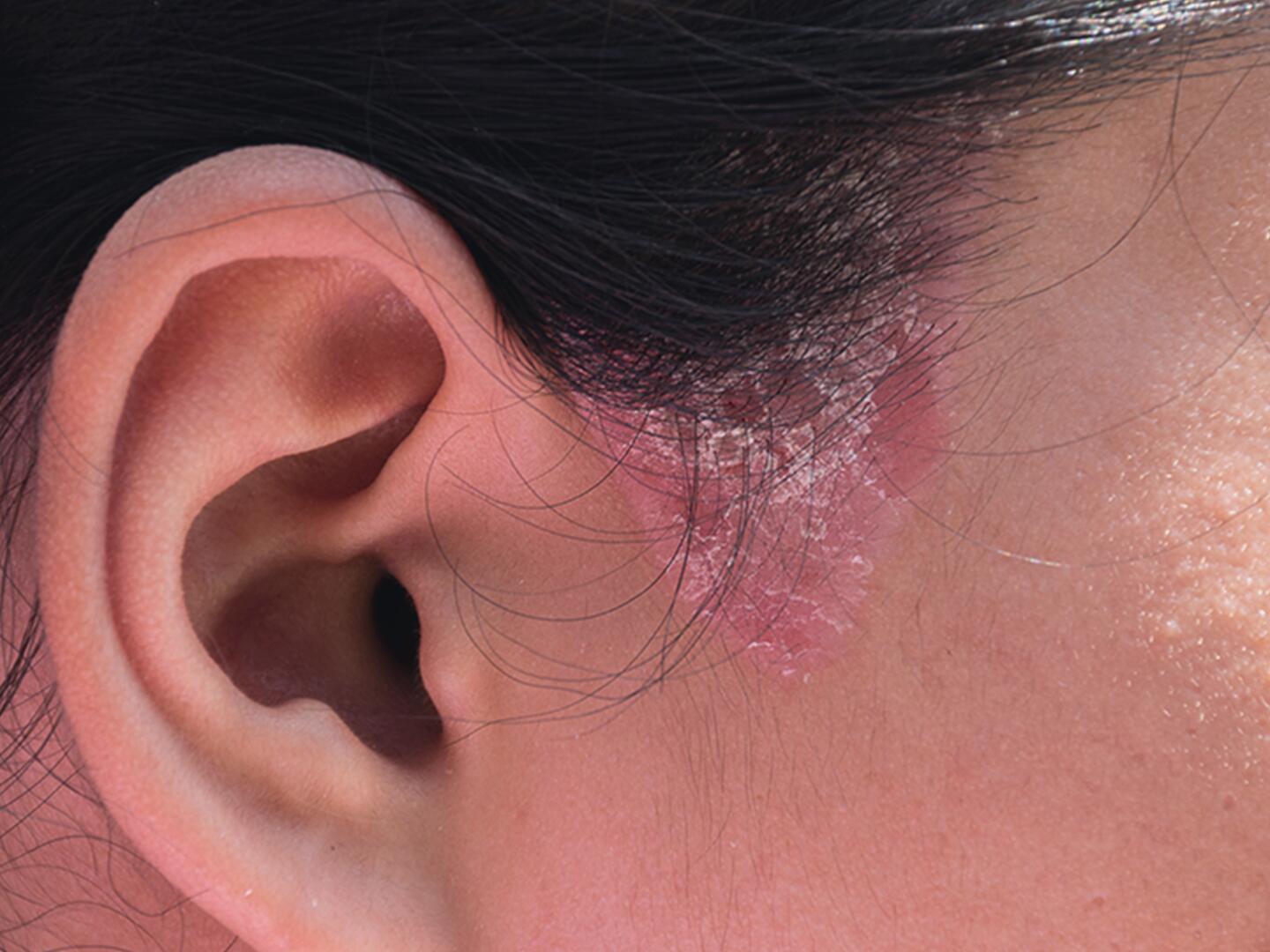 02_Seborrhoisches_Ekzem_Kopfhaut_DU_Seborrhoisches_Ekzem_Kopfhaut_textmodul1-png