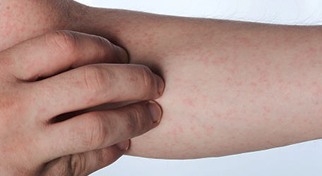 du_neurodermitis_silo_456x250_juckende_haut_ursachen_1