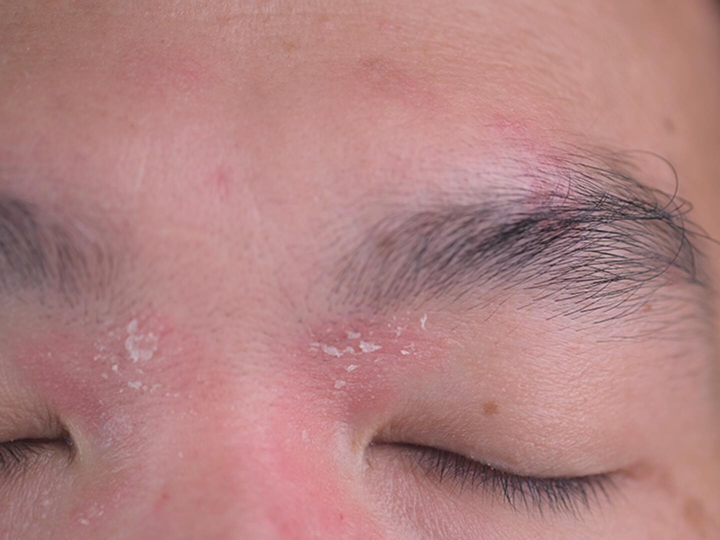 04_Seborrhoisches_Ekzem_Augenbrauen_DU_Seborrhoisches_Ekzem_Augenbrauen_textmodul3-png