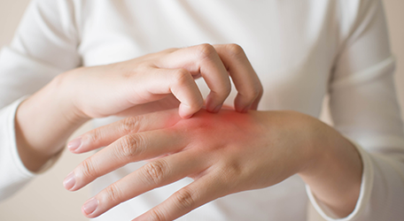 du_silo_456x250_juckende_hande_1_1