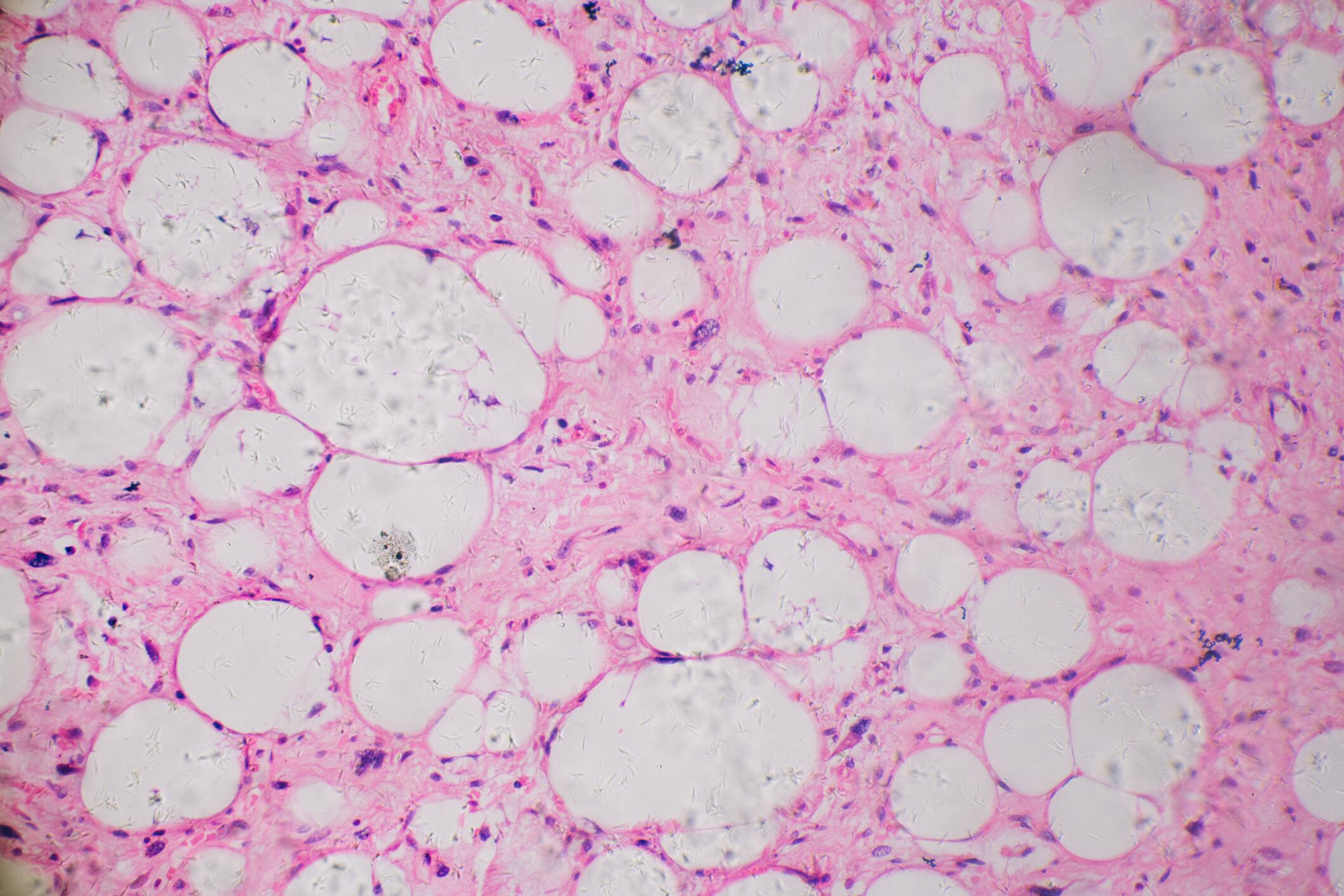 OG_CELLS_CELL_CANCER_ZOOM_MICROSCOPE_ISTOCK_2021