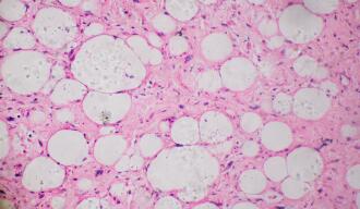OG_CELLS_CELL_CANCER_ZOOM_MICROSCOPE_ISTOCK_2021