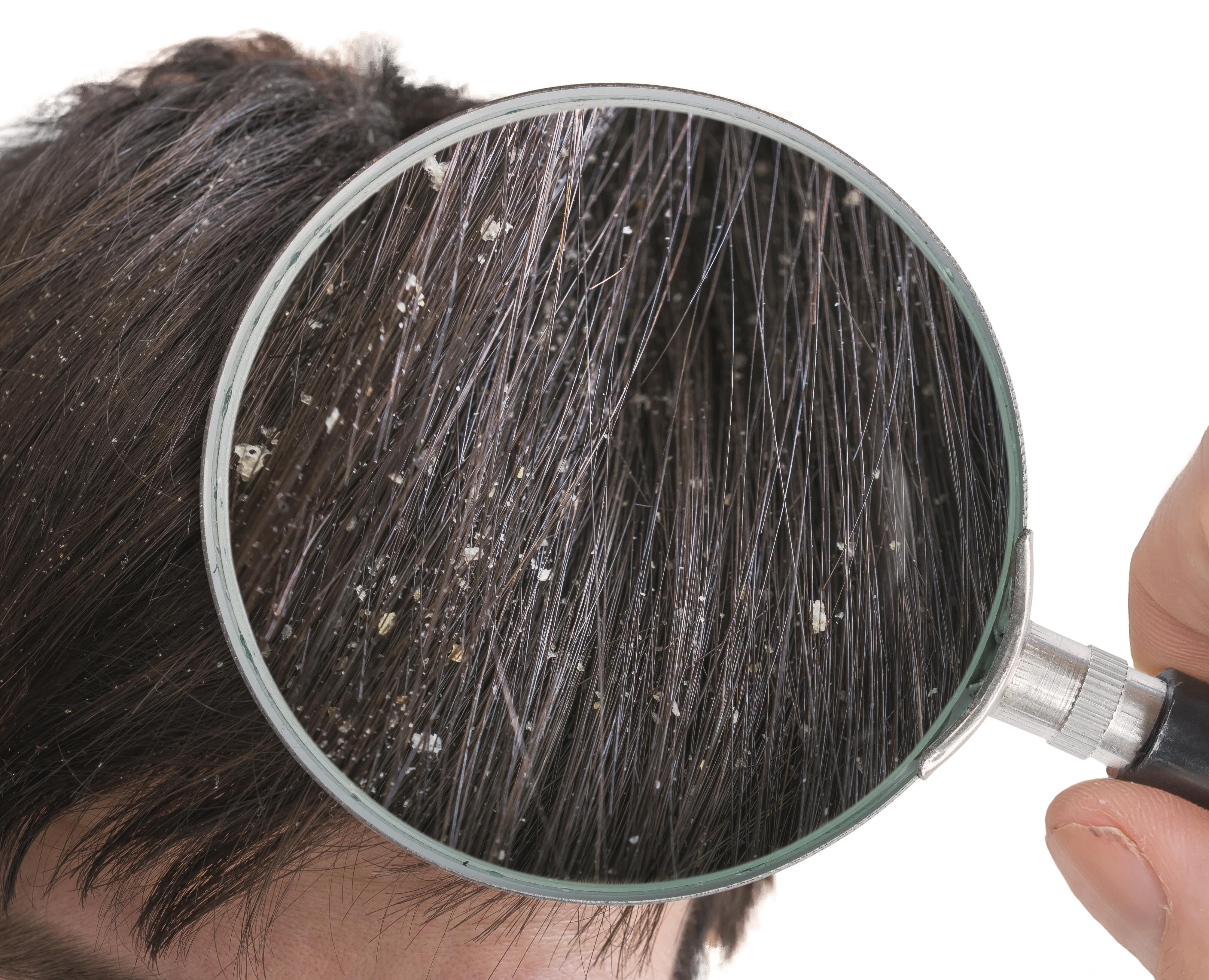 Pellicules dans les cheveux : causes & traitements