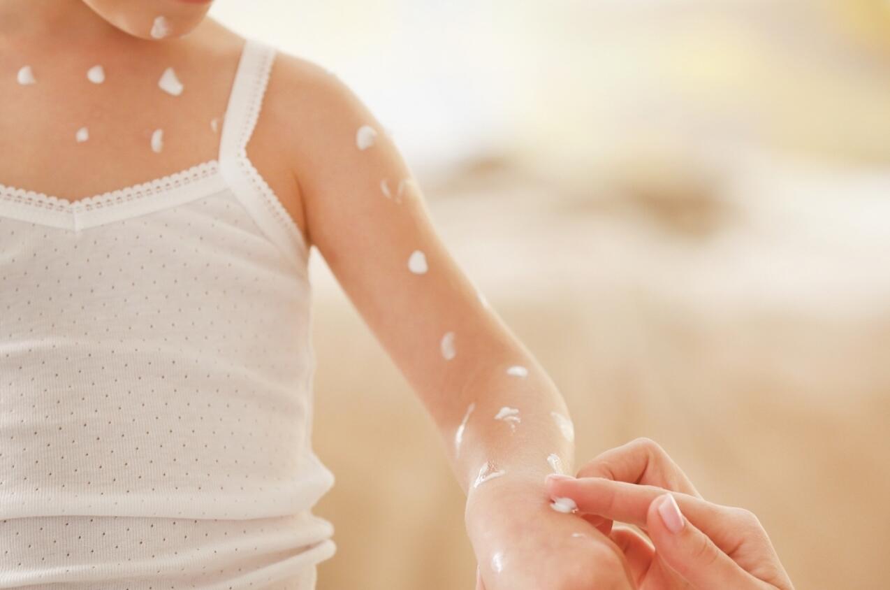 AD_CHICKEN-POX_MOTHER-APPLYING-CHIDS-ARM_LARGE_2021