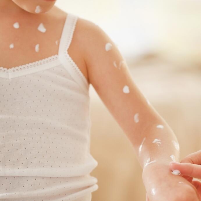 AD_CHICKEN-POX_MOTHER-APPLYING-CHIDS-ARM_LARGE_2021