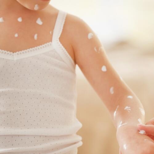 ¿Cómo puedo controlar la varicela de mi hijo?