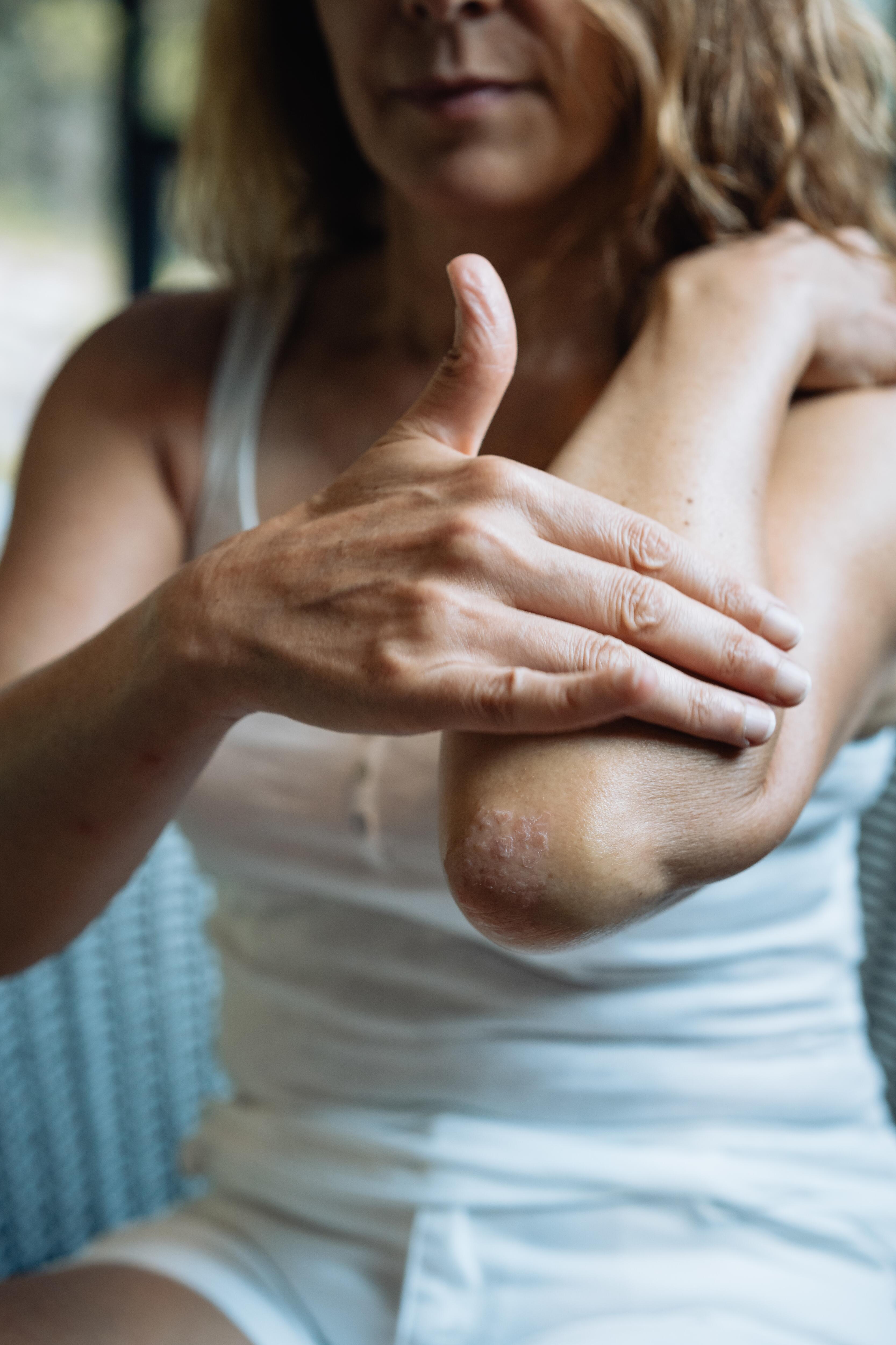 av_psoriasis-patient_care