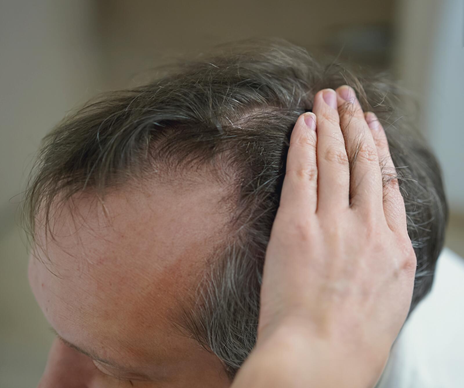 Welche Mittel helfen, um Haarausfall zu stoppen?