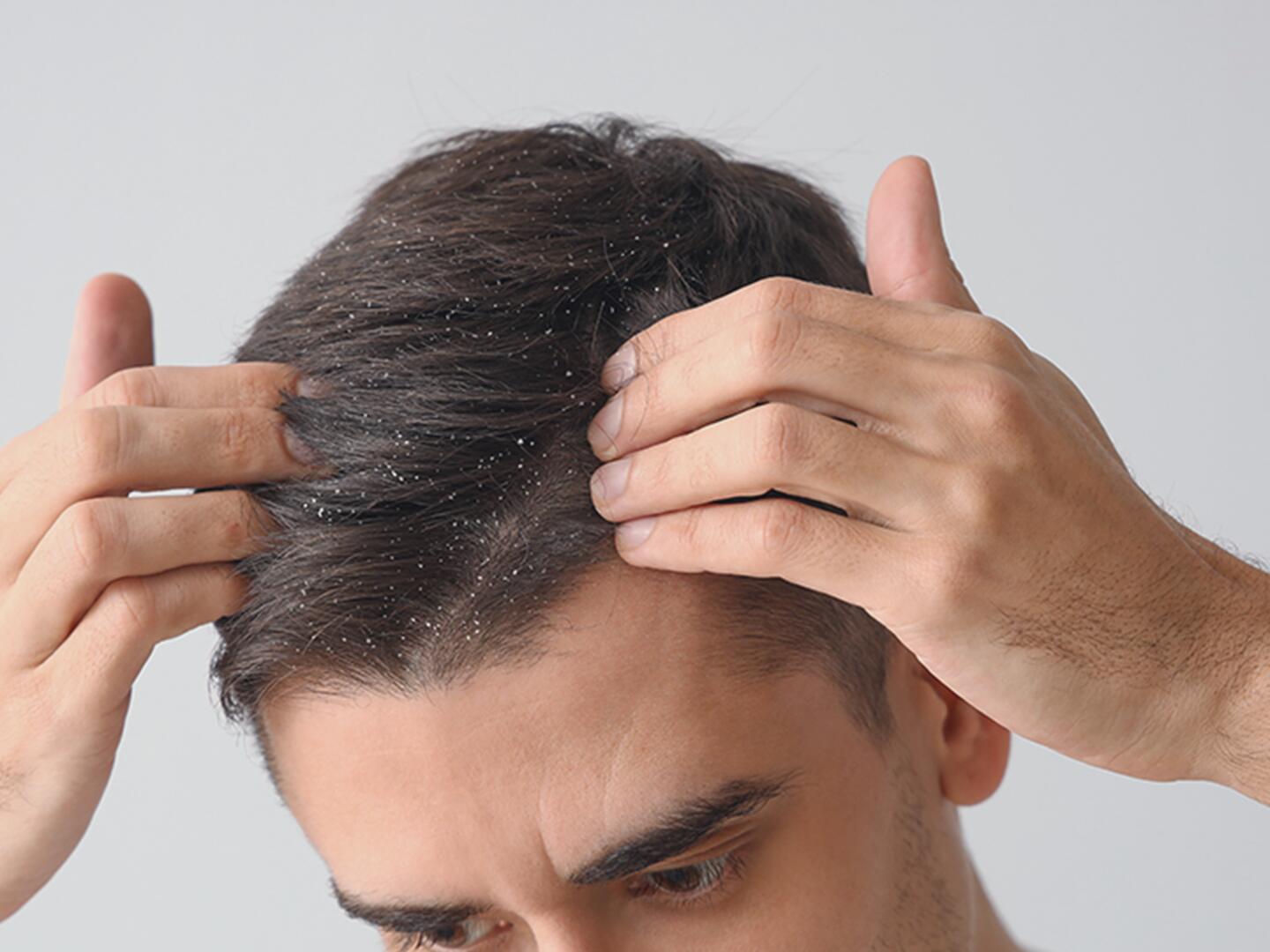 DU_SchuppigeKopfhaut_textmodul1