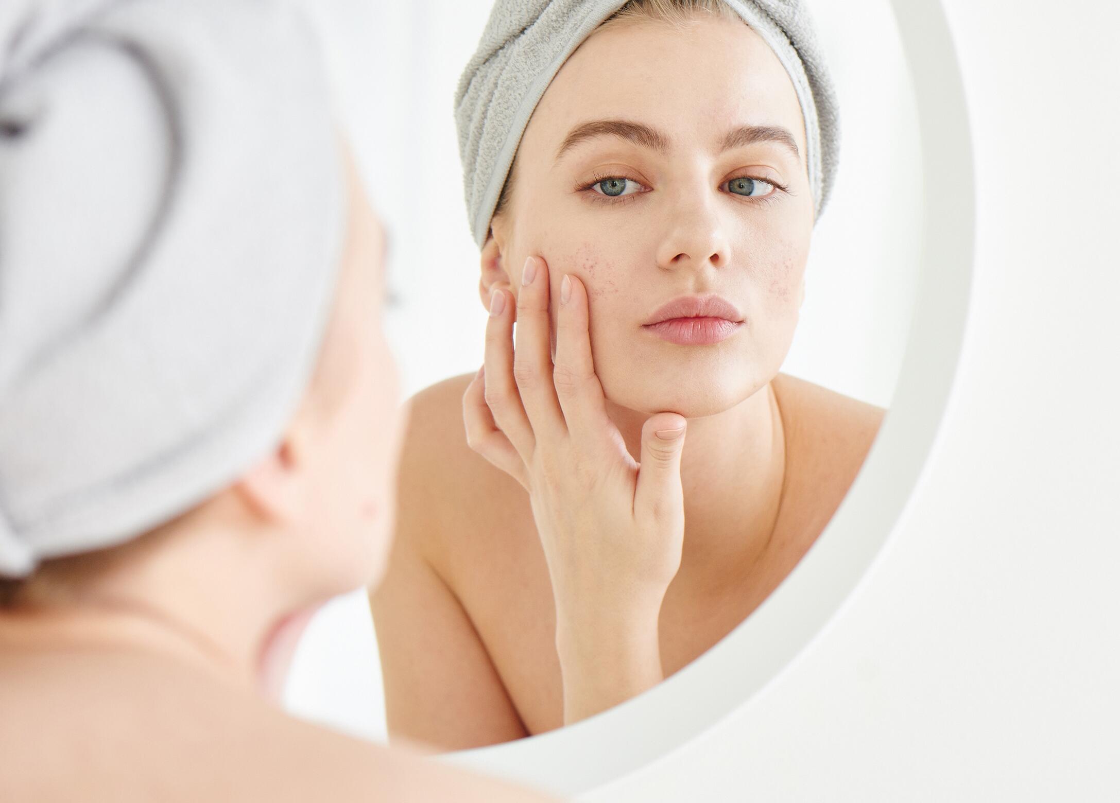 huid en acne: Oplossingen om uw te kalmeren |