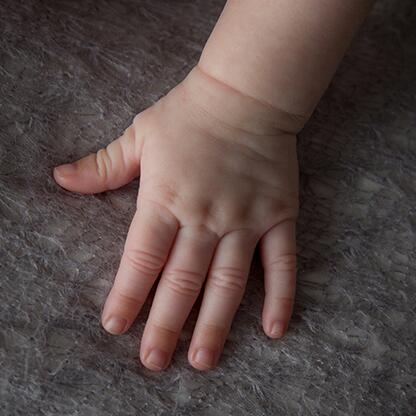 qué provoca la dermatitis atópica en bebés