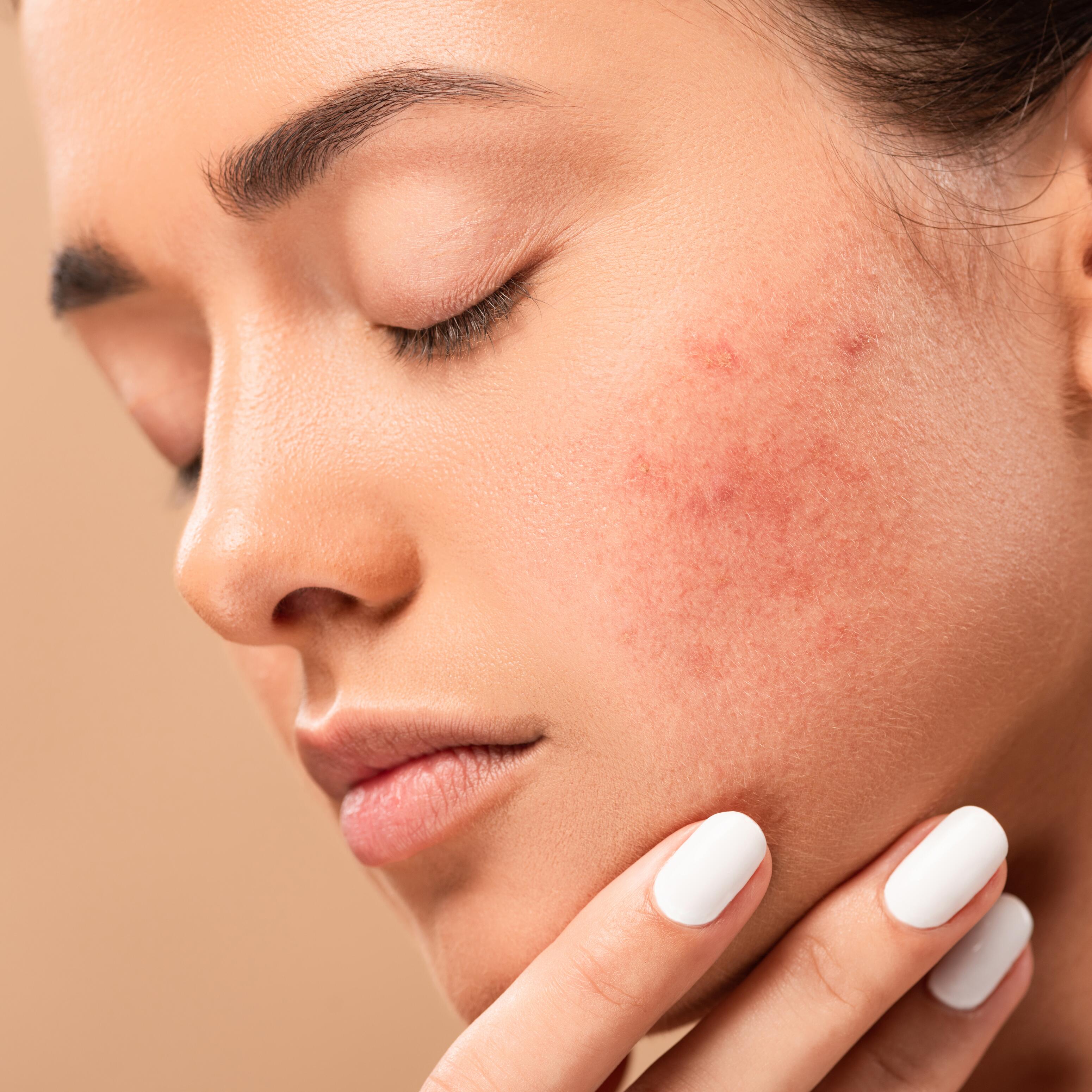 AD_ACNE-INFLAMMATION_SQUARE_2021