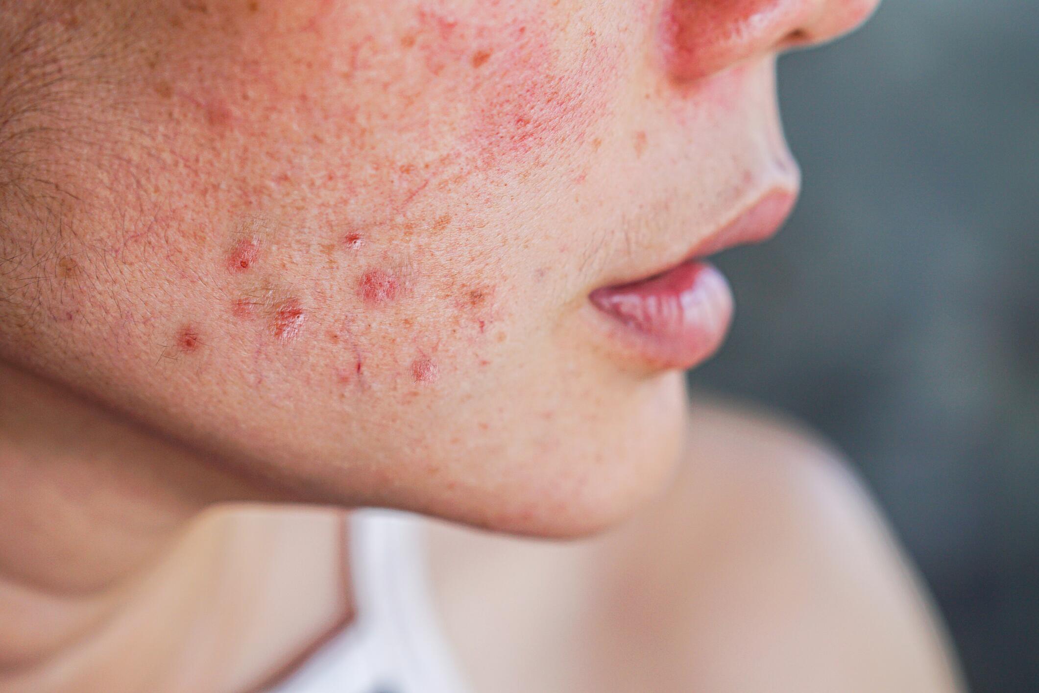 OG_ACNE_RASHES_SCARS_AND_SPOTS_ON_THE_FACE_ISTOCK_2024