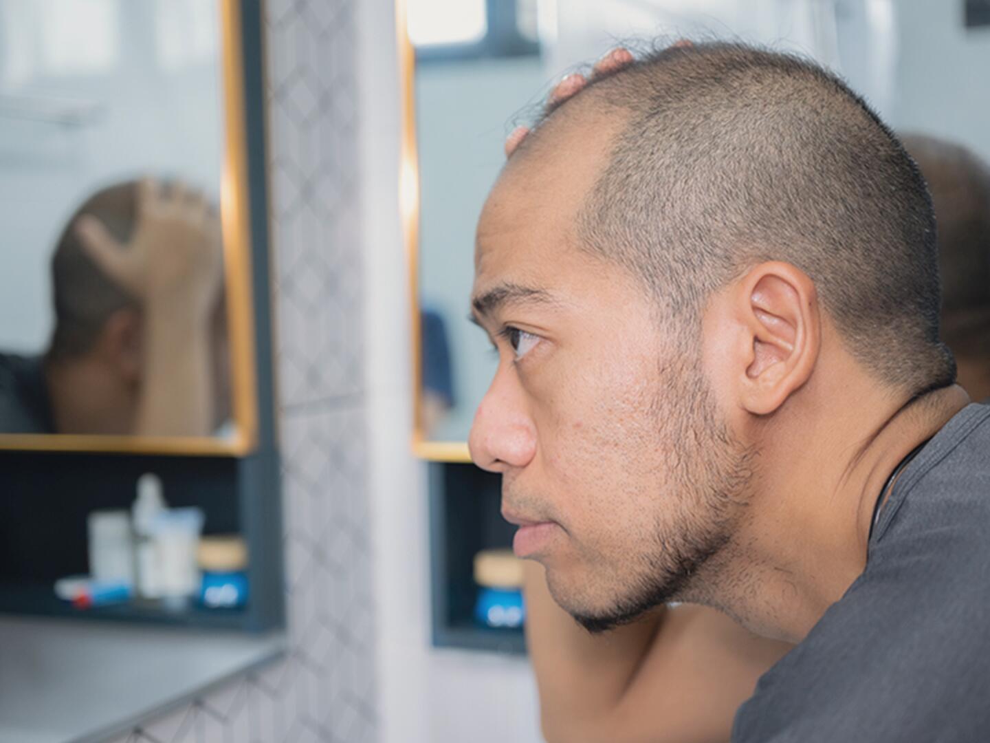 DU_Erblich_bedingter_Haarausfall_Header