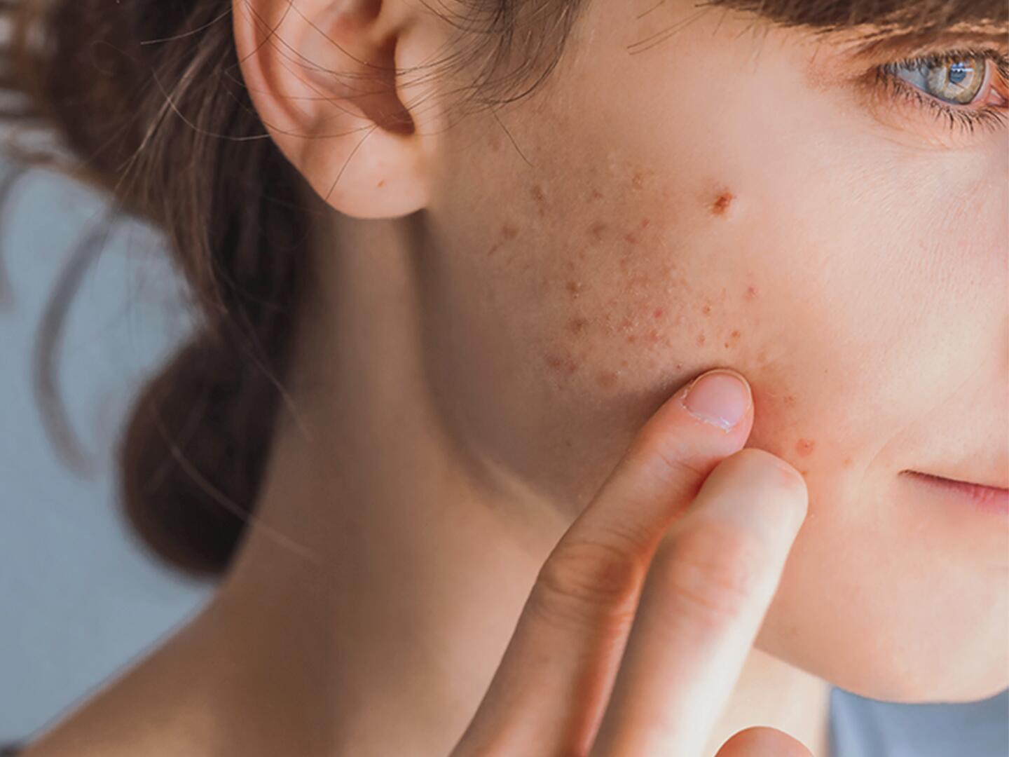 Sonnenallergie im Gesicht Eau Thermale Avène