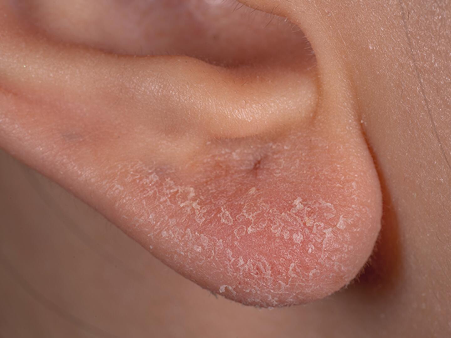 05_Seborrhoisches_Ekzem_Ohr_DU_Seborrhoisches_Ekzem_Ohr_textmodul3-png