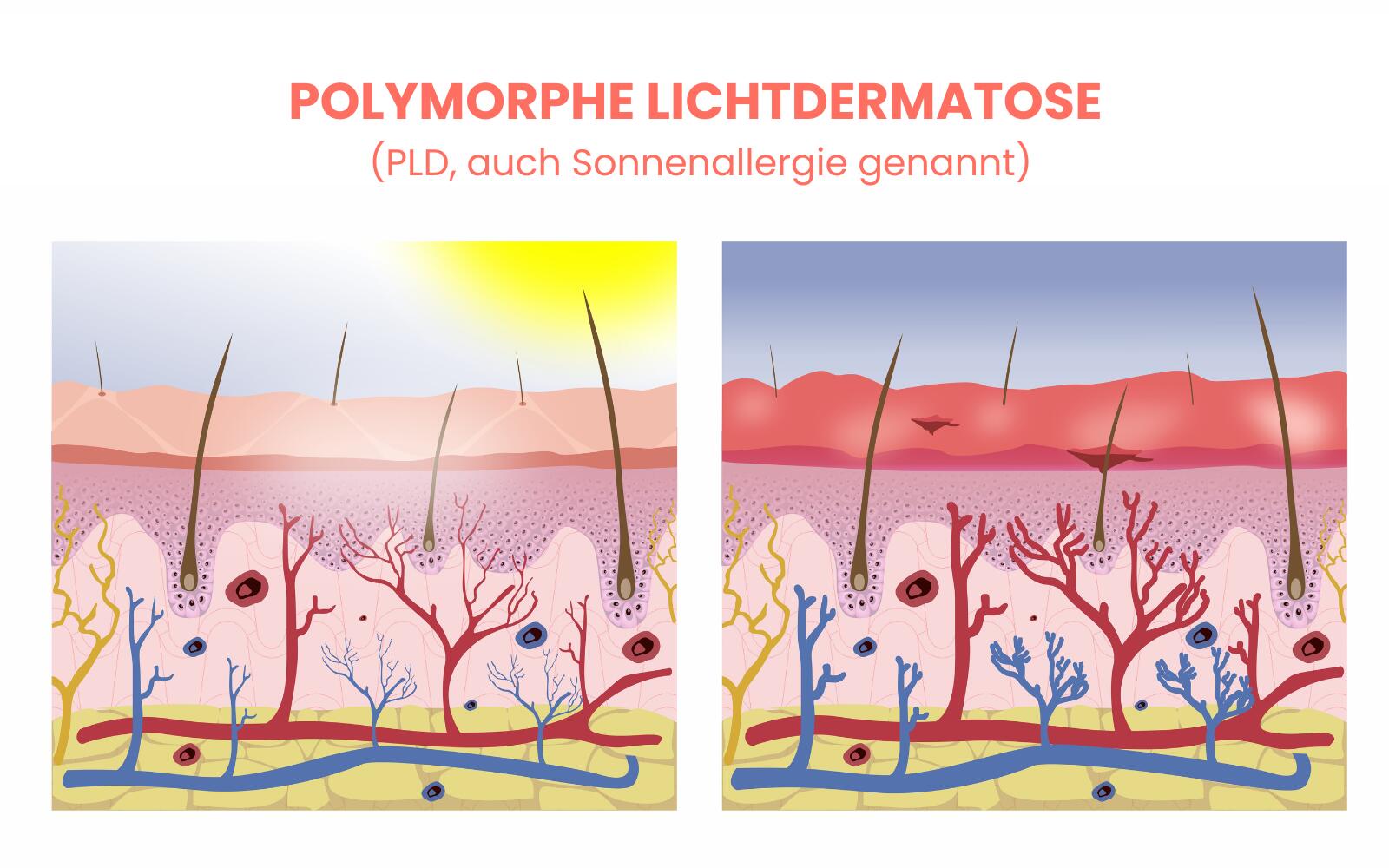 Sonnenallergie Hausmittel | Was ist zu beachten | Eau Thermale Avne