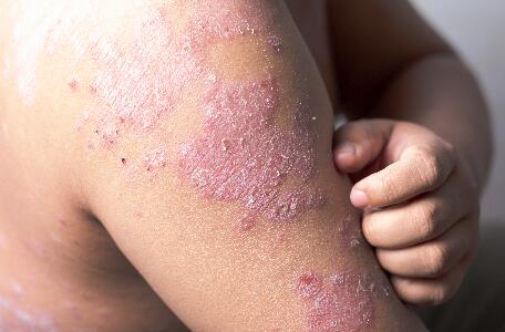 du_neurodermitis_silo_psoriasis_symptome