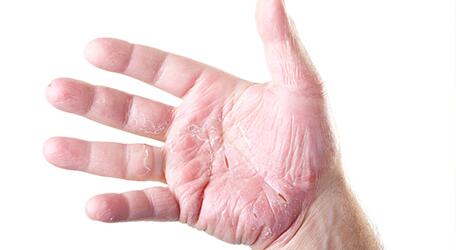 du_neurodermitis_silo_hand-ekzeme