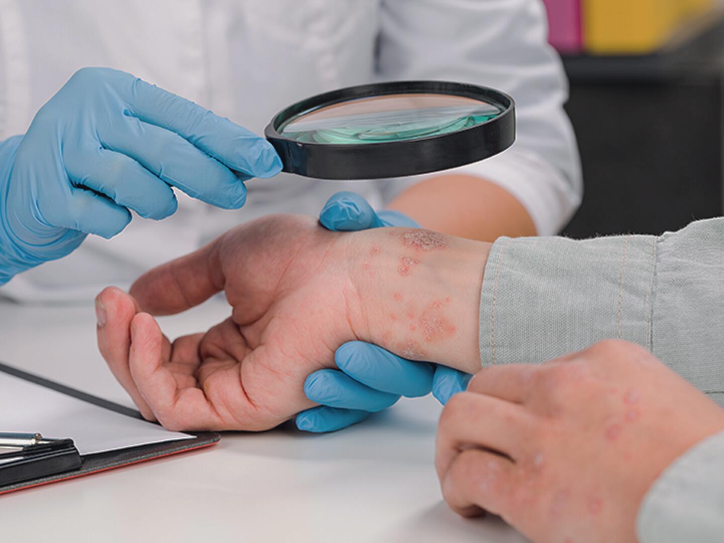 DU_Psoriasisvulgaris_textmodul4