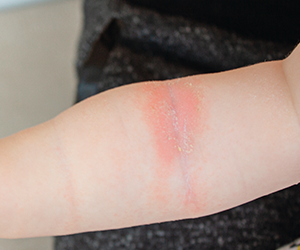 DU_SENSINOL_SILO_JUCKREIZ_HAUTAUSSCHLAG_CONTENT_BANNER