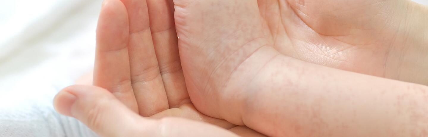 cuidado de la piel con dermatitis atópica en bebés