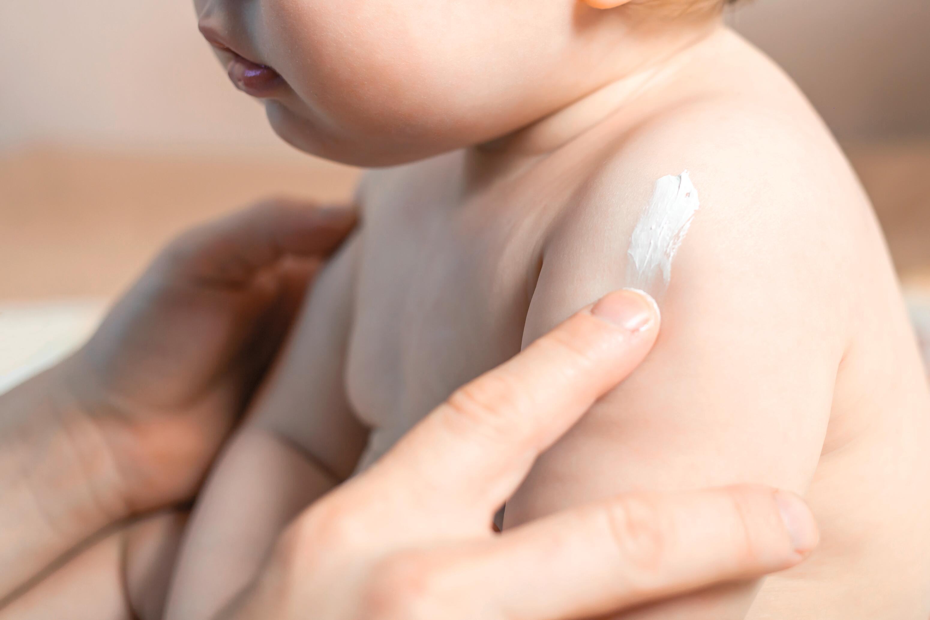 AD_WEBSITE_BANNER_eczema_2025