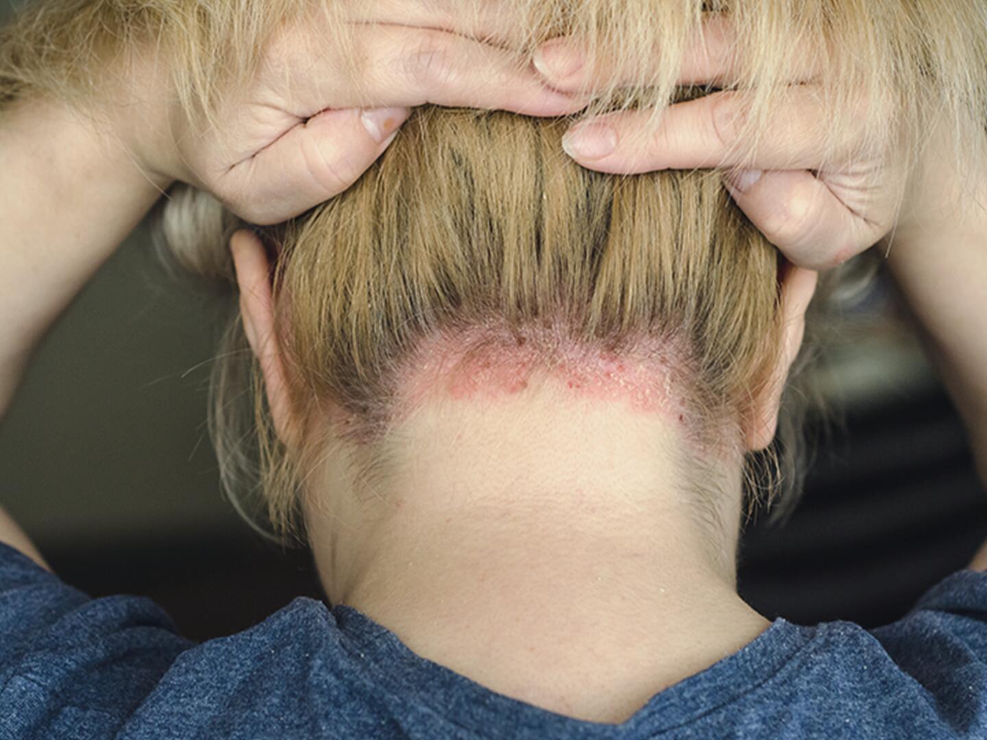 06_Seborrhoisches_Ekzem_DU_Seborrhoisches_Ekzem_textmodul3-png