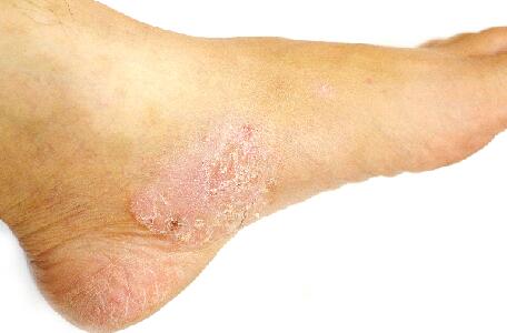 du_neurodermitis_silo_fuss_psoriasis