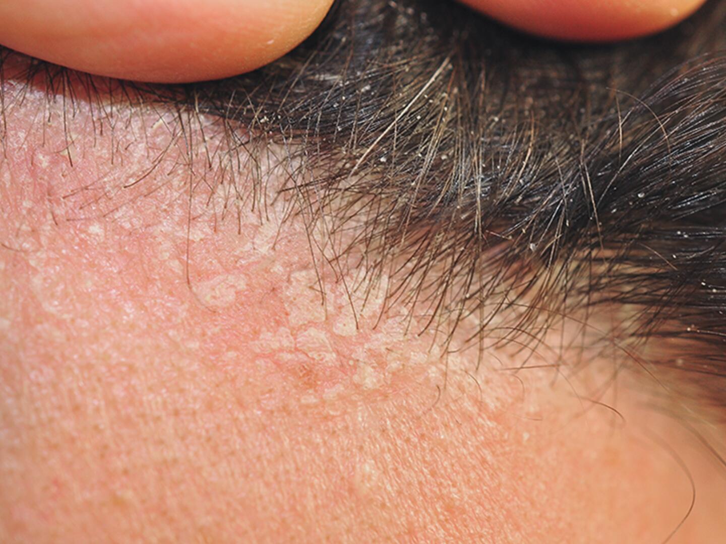 02_Seborrhoisches_Ekzem_Kopfhaut_DU_Seborrhoisches_Ekzem_Kopfhaut_textmodul2-png