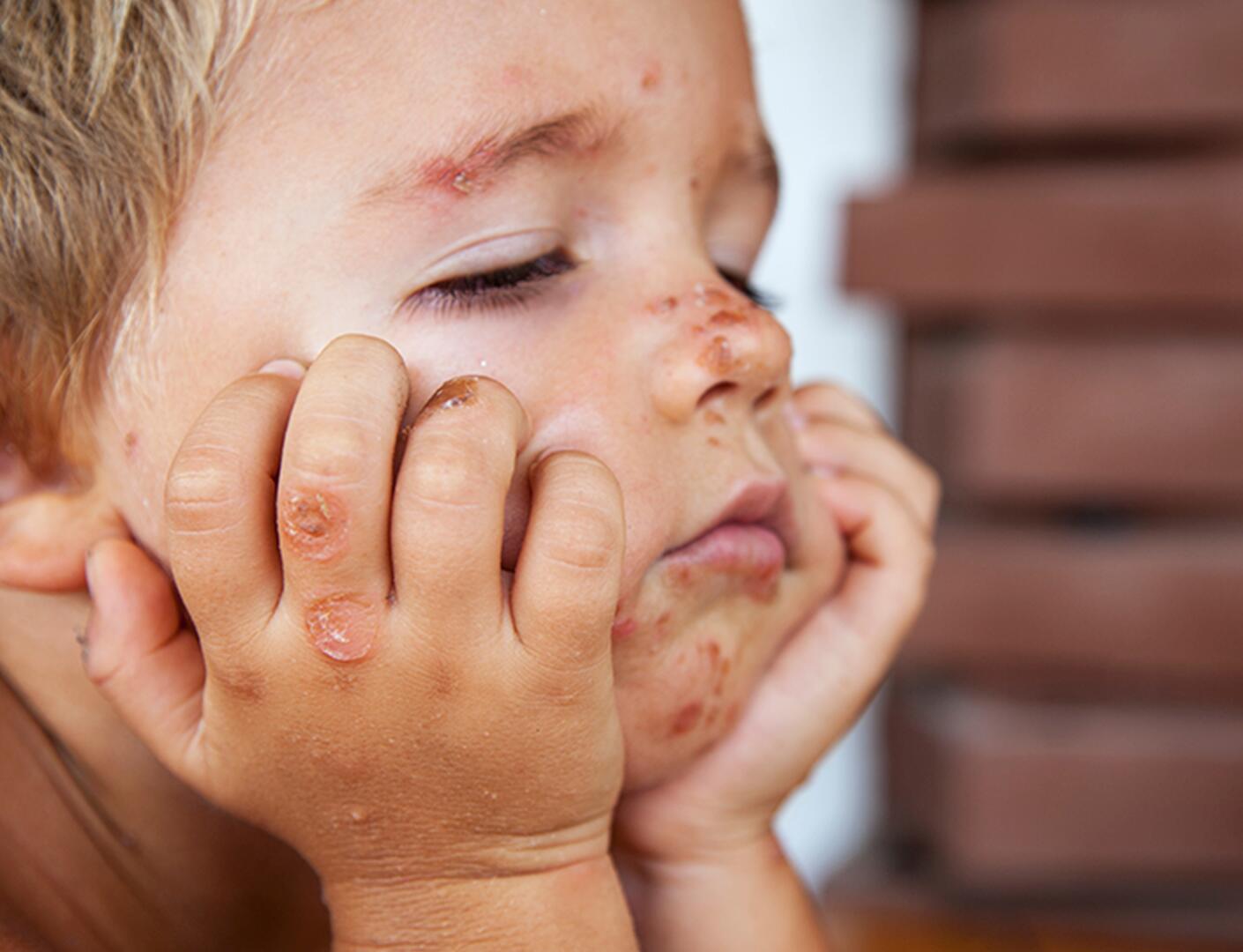 du_neurodermitis_silo_psoriasis_kinder_textmodul2_desktop_705x540