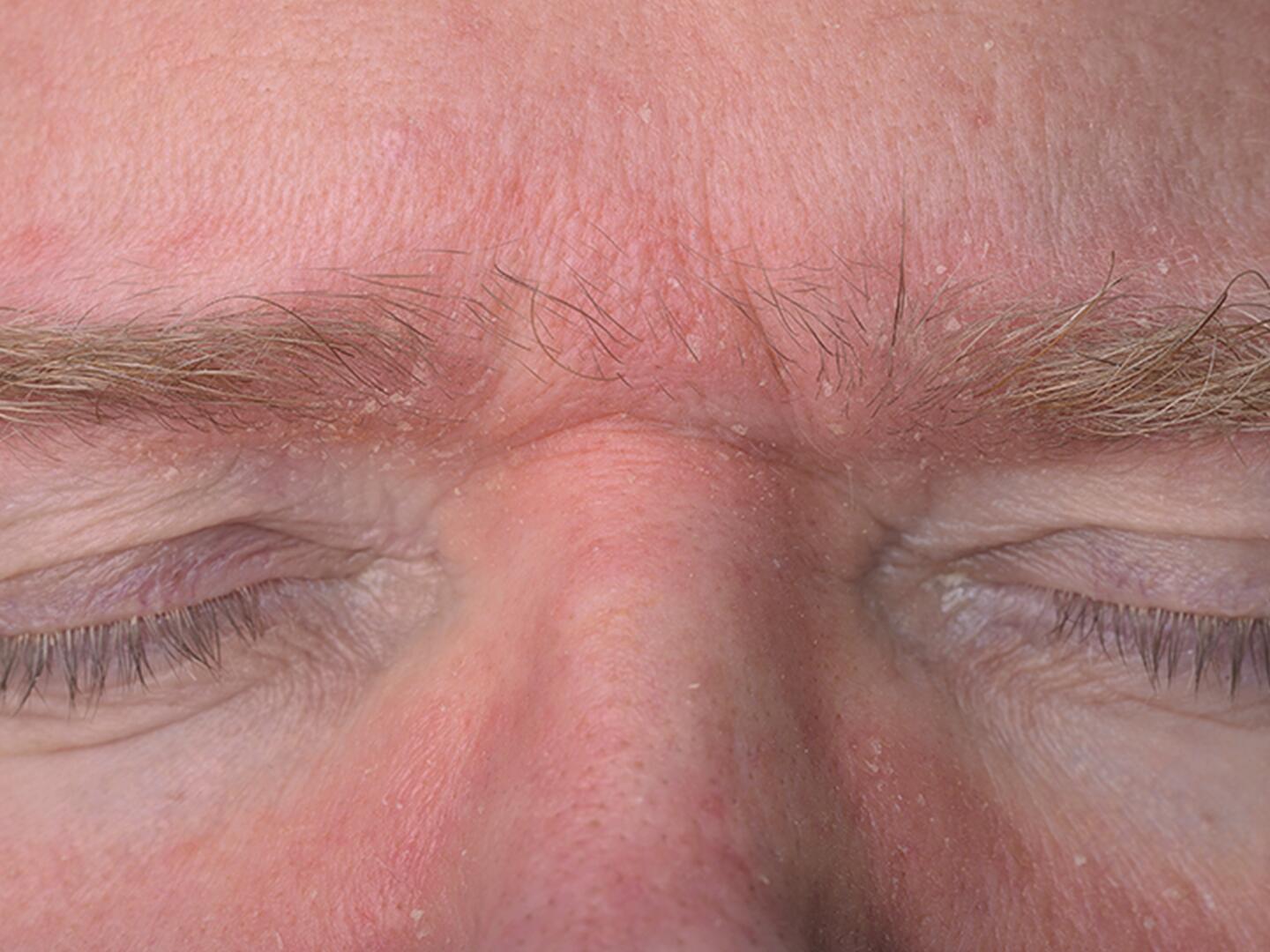 04_Seborrhoisches_Ekzem_Augenbrauen_DU_Seborrhoisches_Ekzem_Augenbrauen_textmodul2-png