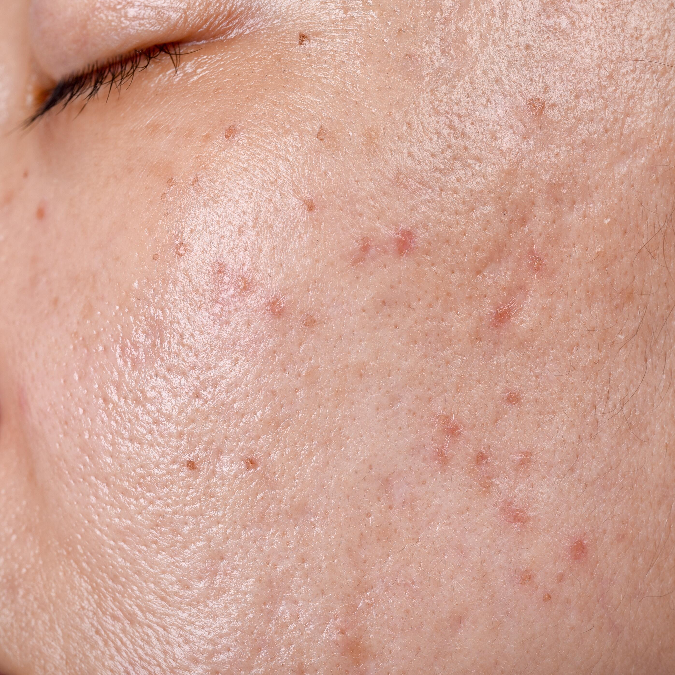 AD_ACNE_RED-SCAR_SQUARE