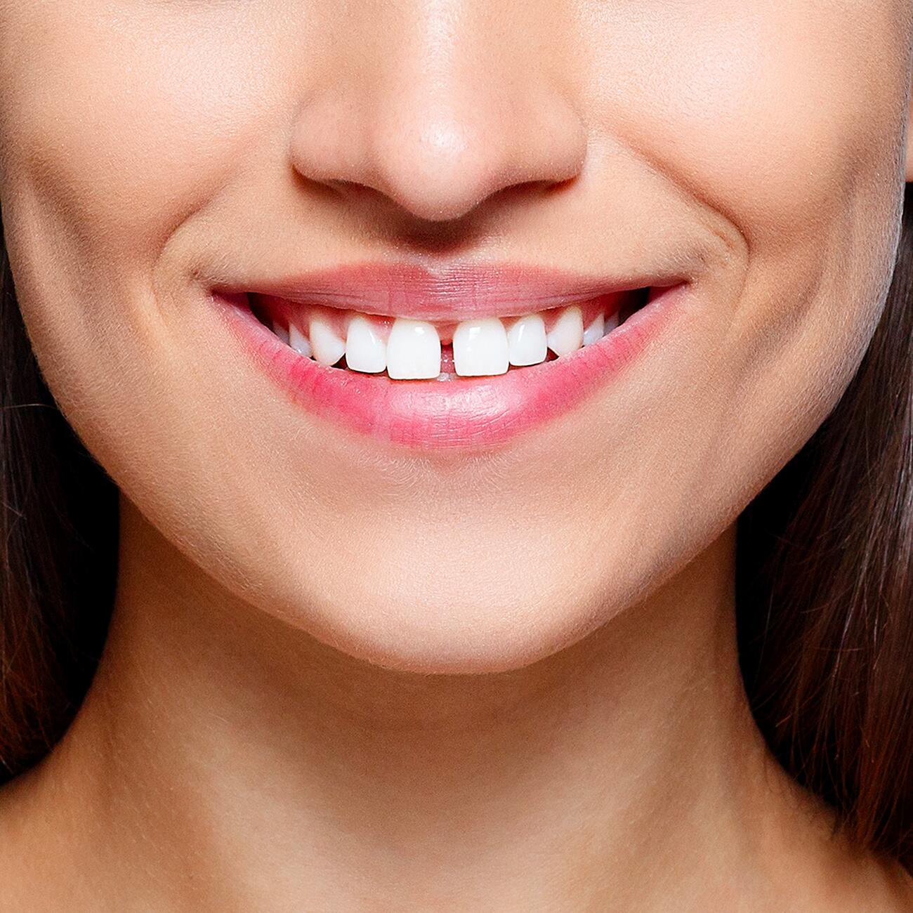 Comment entretenir un blanchiment dentaire, et quelles précautions prendre  ?