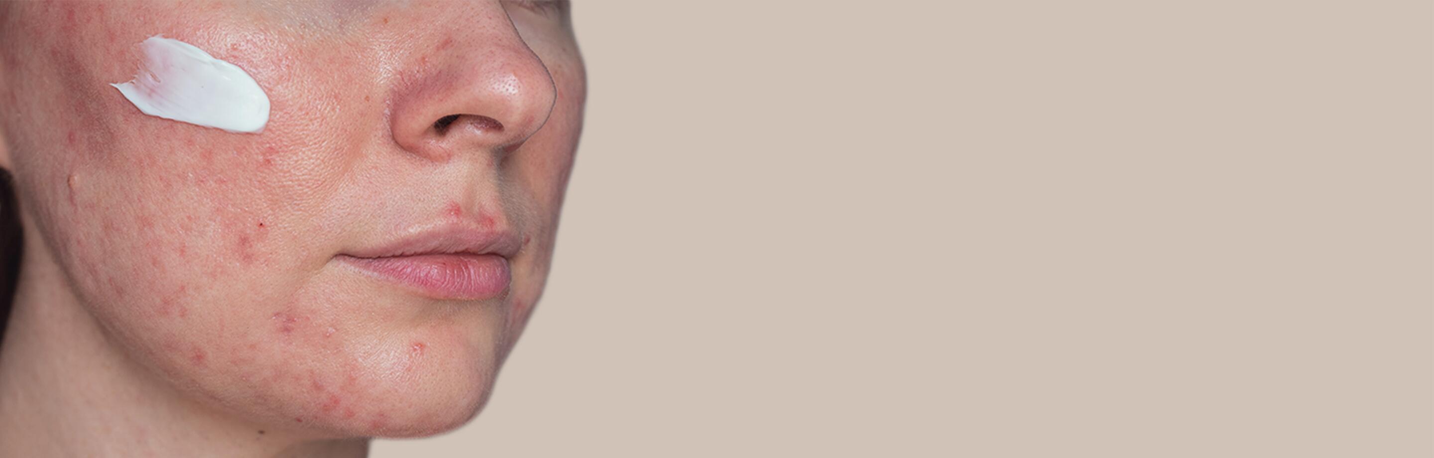 AV_Rosacea-Nase_Desktop_1440x460