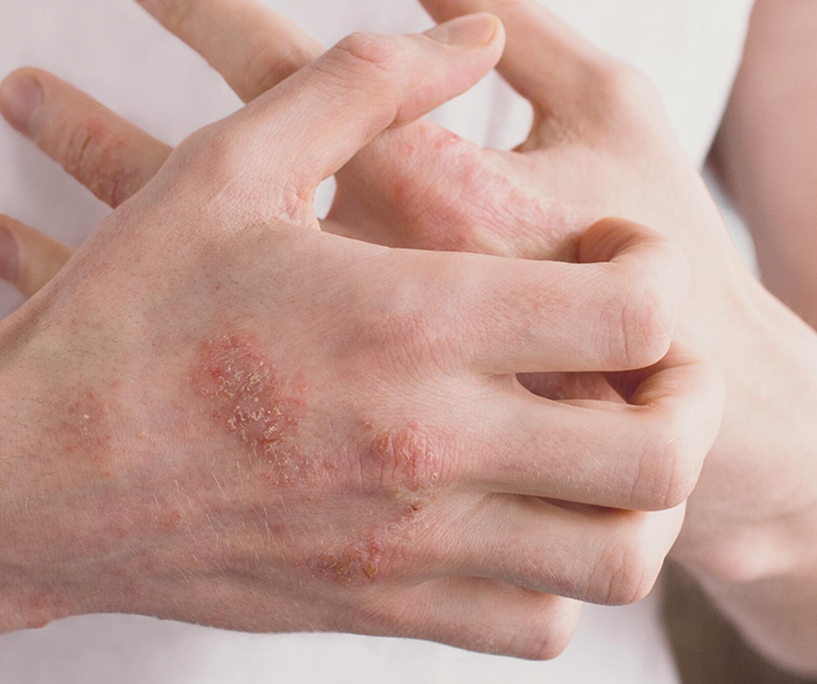 Psoriasis Vulgaris | Ducray