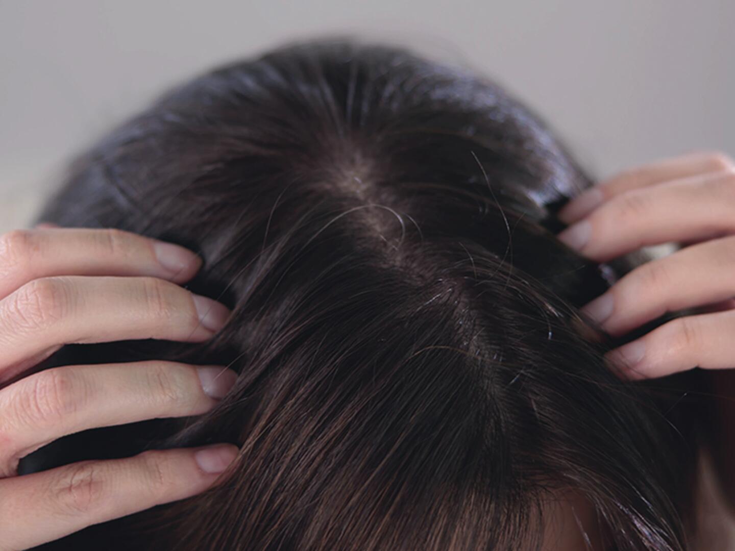 02_Seborrhoisches_Ekzem_Kopfhaut_DU_Seborrhoisches_Ekzem_Kopfhaut_textmodul3-png