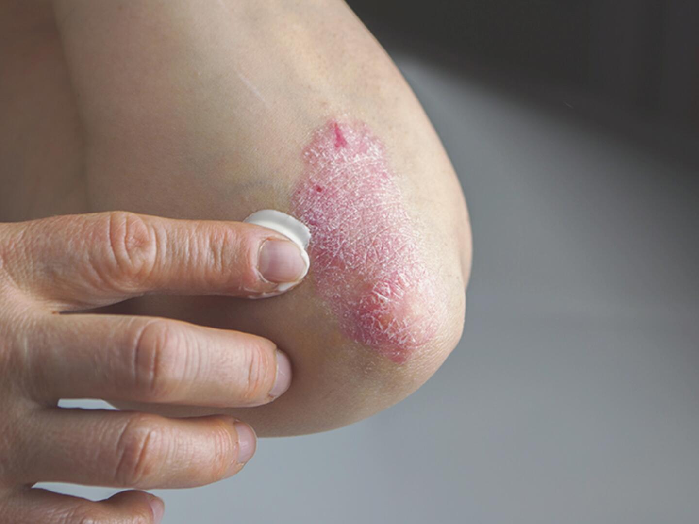 DU_Psoriasisvulgaris_textmodul3