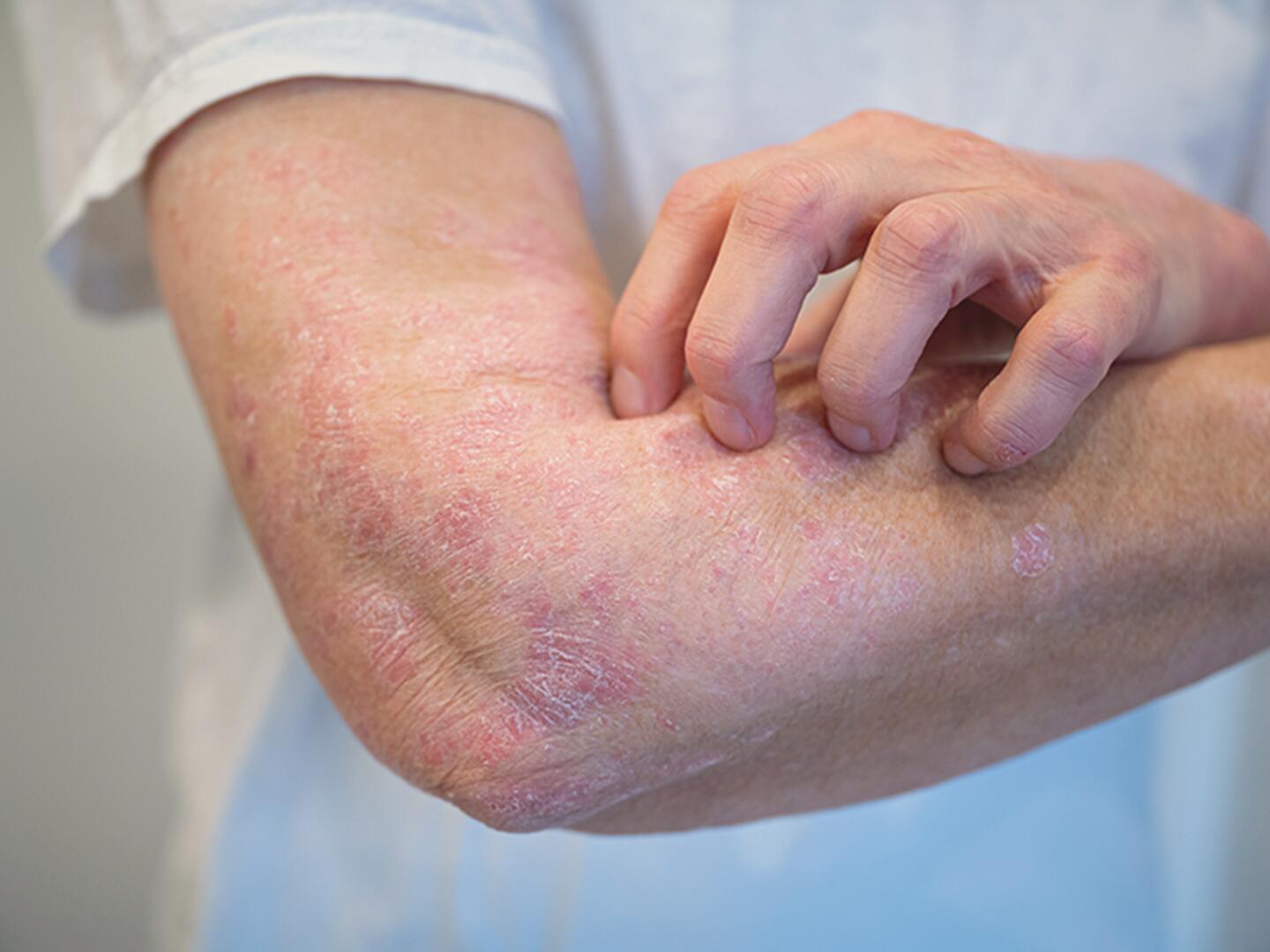 DU_Psoriasisvulgaris_textmodul2