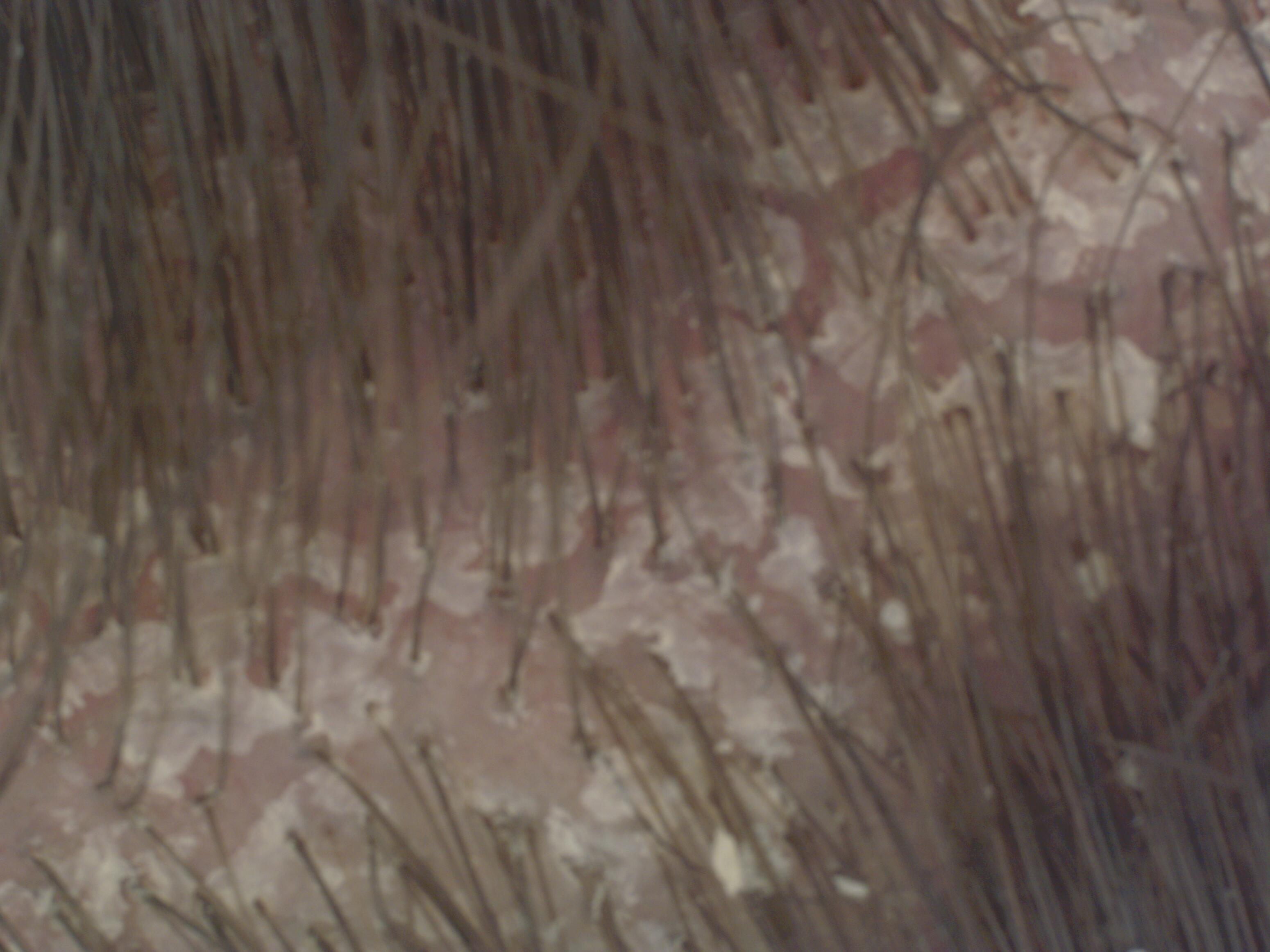 rf_neopur_pellicules-grasses