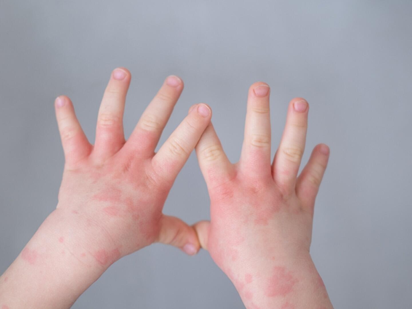 Symptome, Ursachen und Pflegetipps gegen trockene und schuppige Haut bei kleinen Kindern und Neugeborenen