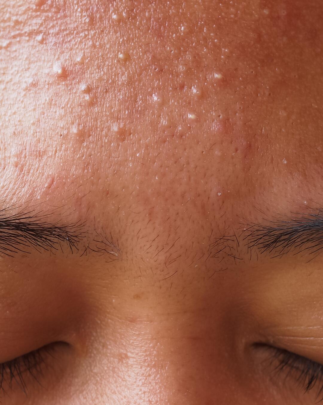 Boutons, points noirs… Pourquoi a-t-on de l'acné à l'âge adulte ? –  Laboratoire Dermatologique Dermina