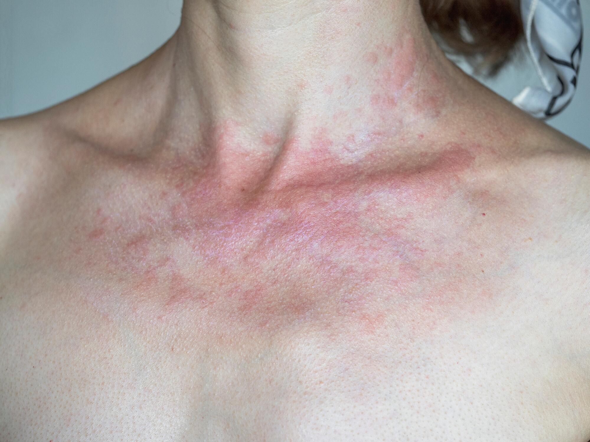 OG_SOLAR_DERMATITIS_WOMAN_WITH_RED_SKIN_BURNED_BY_THE_SUN_ISTOCK_2023