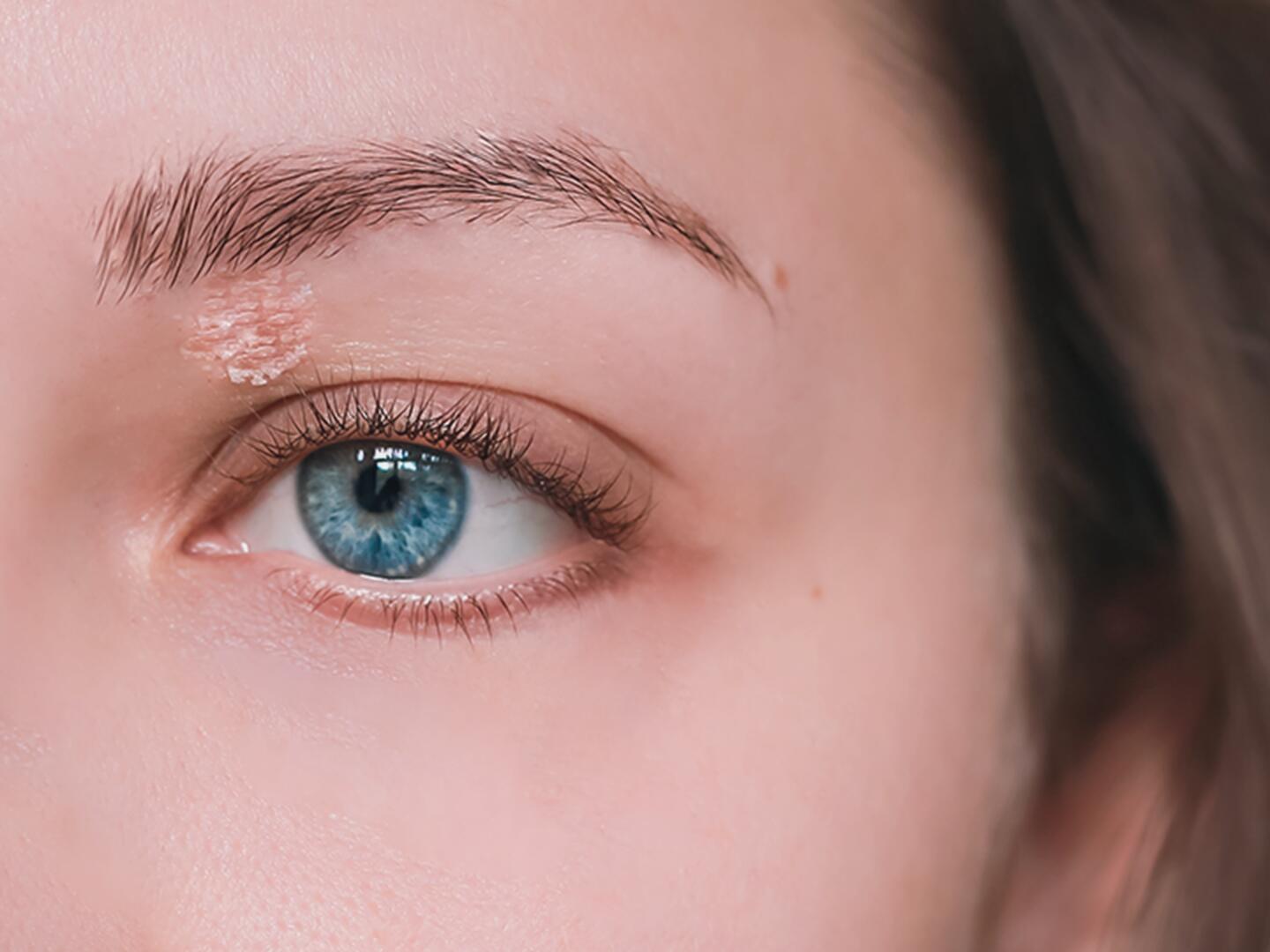 04_Seborrhoisches_Ekzem_Augenbrauen_DU_Seborrhoisches_Ekzem_Augenbrauen_textmodul1-png